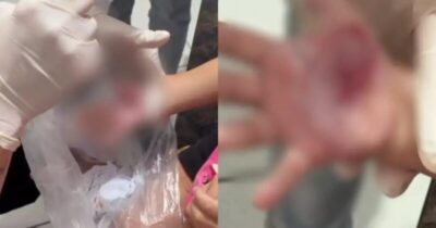 Madrasta que derreteu mão de criança em Itajaí é solta após castigo chocante; Entenda o motivo bárbaro