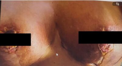 Médico de lipoaspiração fatal na dona da franquia Cacau Show também é acusado de mutilar outras pacientes