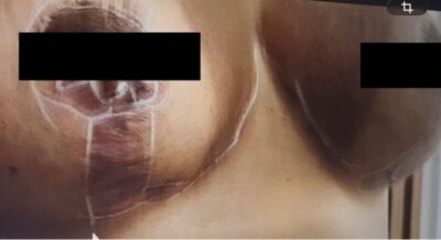 Médico de lipoaspiração fatal na dona da franquia Cacau Show também é acusado de mutilar outras pacientes