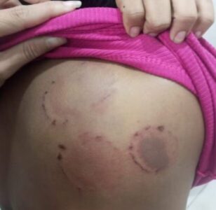 Homem é preso em flagrante após agredir a namorada com socos e mordidas em Pinheiro