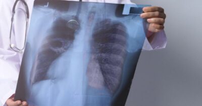 Casos de tuberculose crescem 34% em cinco anos no Maranhão