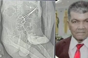 Homem morre após cirurgia e família diz que pinça foi deixada no corpo