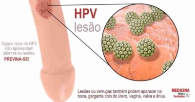 HPV pode ser transmitido pelo sexo oral e aumentar risco de câncer de garganta