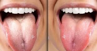 Você está com a língua branca? Entenda o que essa condição revela sobre a saúde bucal