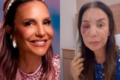 VÍDEO! Ivete Sangalo mostra rosto com hematoma e revela detalhes detalhes da longa cirurgia em São Paulo