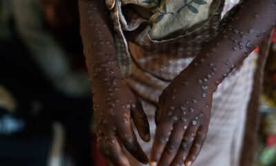 Sobe para 140 número de casos confirmados de Mpox no Brasil em 2026