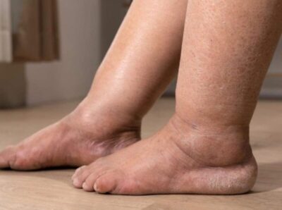 Inchaço nas pernas pode ser lipedema ou linfedema: saiba como identificar