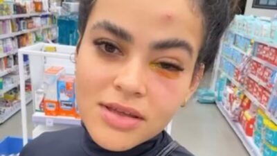 Influenciadora viraliza após infecção no olho causada por mosca de banheiro