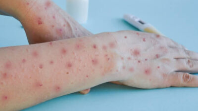 Mpox, varíola e catapora: entenda as diferenças entre as doenças