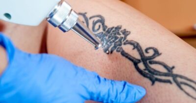 Brasil é o 2º país que mais busca por remoção de tatuagens