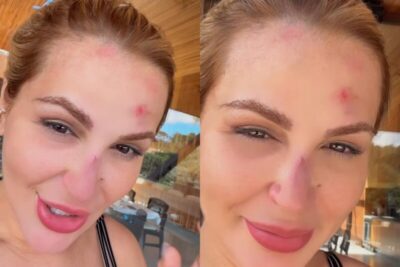 Deolane Bezerra surge com rosto machucado após acidente doméstico