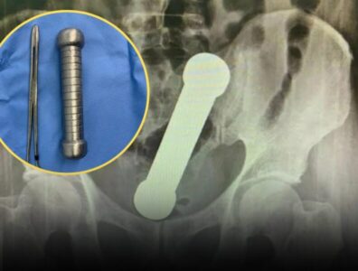 caso bizarro de objeto introduzido no reto vira estudo médico internacional