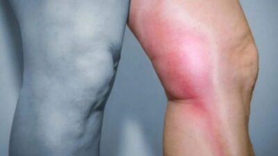 No Dia Mundial da Saúde, especialistas alertam para a prevenção das doenças vasculares